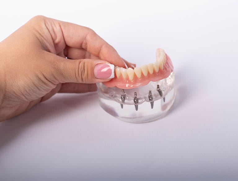 All-On-4® dental implant