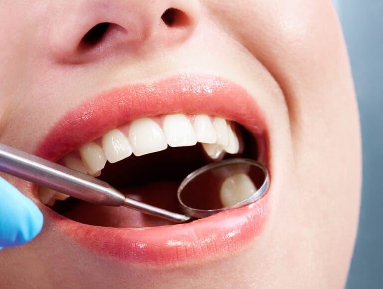 Restoring Smiles with Fillings