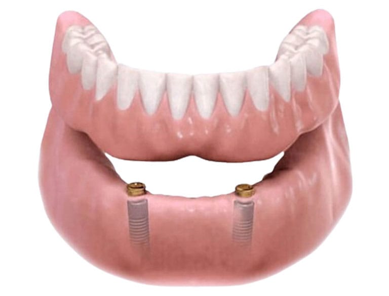 fixed and removable dental implant