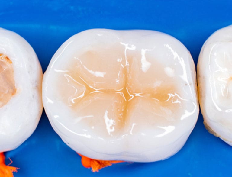 Shielding Teeth with Dental Sealants