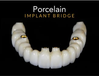 porcelain implant bridge